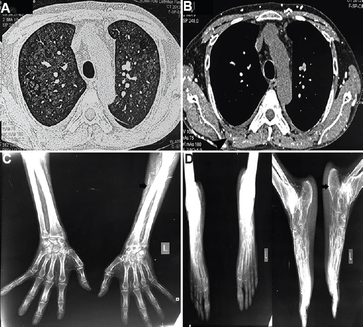 High-resolution computed tomography of the thorax demonstrating (A) diffuse ground-glass opacification in the lung window and (B) multiple calcified vessels (arrowhead) in the mediastinal window. X-ray of the bilateral (C) upper and (D) lower limbs revealing arterial calcification of arteries (arrows).